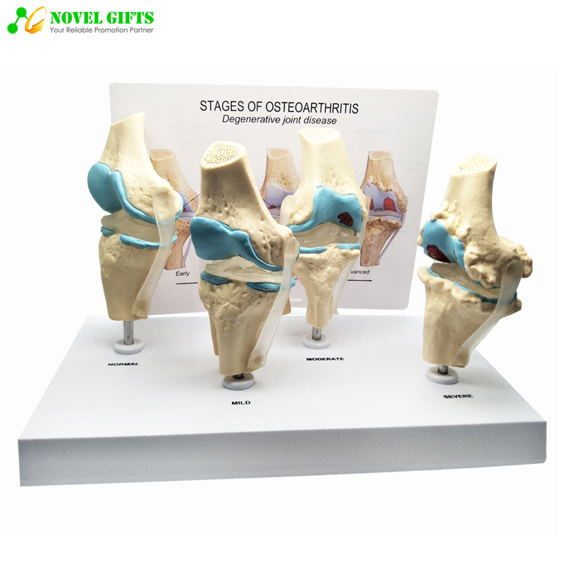 Anatomical Human Osteoarthritis Bone Model